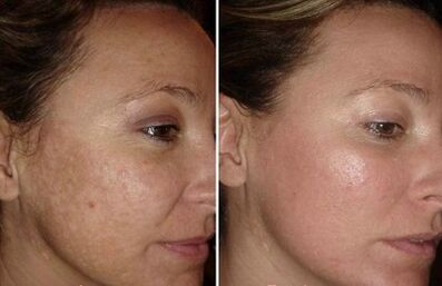 rejuvenecimiento facial con láser fotos antes y después