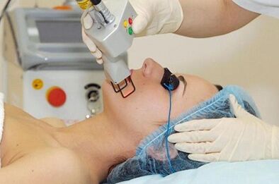 tipos de rejuvenecimiento cutáneo facial con láser